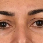 Blepharoplasty Before & After Patient #557