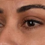 Blepharoplasty Before & After Patient #557