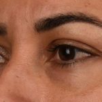 Blepharoplasty Before & After Patient #557