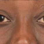 Facial Fat Grafting Before & After Patient #1222