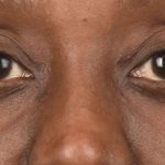 Facial Fat Grafting Before & After Patient #1222