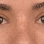 Blepharoplasty Before & After Patient #522