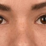 Blepharoplasty Before & After Patient #522