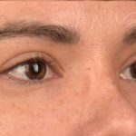 Blepharoplasty Before & After Patient #522