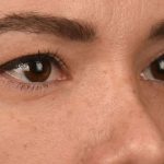 Blepharoplasty Before & After Patient #522