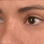 Blepharoplasty Before & After Patient #522