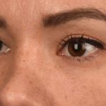 Blepharoplasty Before & After Patient #522