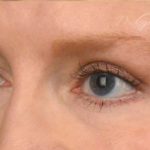 Blepharoplasty Before & After Patient #512