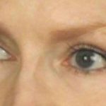 Blepharoplasty Before & After Patient #512