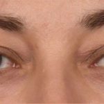 Blepharoplasty Before & After Patient #395