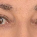 Blepharoplasty Before & After Patient #395