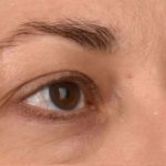 Blepharoplasty Before & After Patient #395