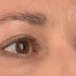 Blepharoplasty Before & After Patient #395