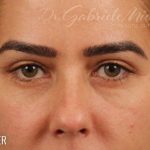 Blepharoplasty Before & After Patient #711