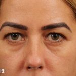 Blepharoplasty Before & After Patient #711
