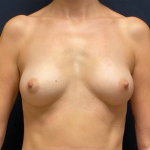 Fat Transfer Breast Augmentation Before & After Patient #1515
