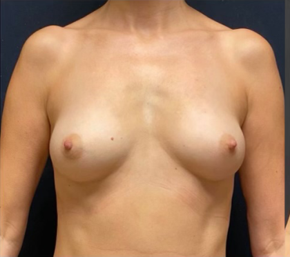 Fat Transfer Breast Augmentation Before & After Patient #1515