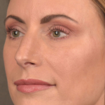 Facial Fat Grafting Before & After Patient #1250