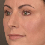 Facial Fat Grafting Before & After Patient #1250
