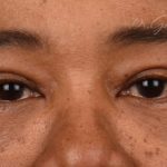 Blepharoplasty Before & After Patient #542
