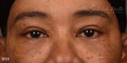 Blepharoplasty Before & After Patient #542