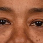 Blepharoplasty Before & After Patient #542