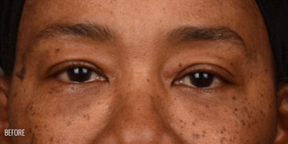 Blepharoplasty Before & After Patient #542