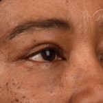 Blepharoplasty Before & After Patient #542