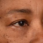 Blepharoplasty Before & After Patient #542