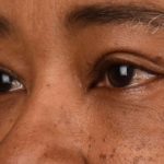 Blepharoplasty Before & After Patient #542
