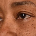 Blepharoplasty Before & After Patient #542