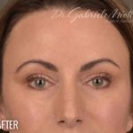 Dark Circles and Eyelid Bags Before & After Patient #1406