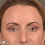 Dark Circles and Eyelid Bags Before & After Patient #1406