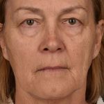 Skin Resurfacing Before & After Patient #1342