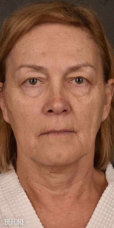 Skin Resurfacing Before & After Patient #1342