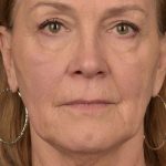 Skin Resurfacing Before & After Patient #1342