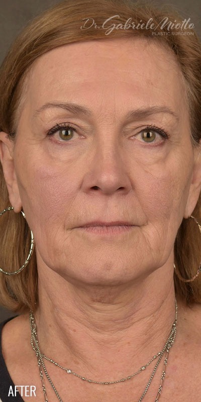 Skin Resurfacing Before & After Patient #1342