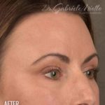 Dark Circles and Eyelid Bags Before & After Patient #1406
