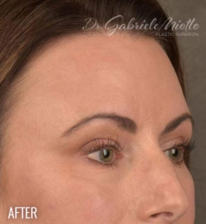 Dark Circles and Eyelid Bags Before & After Patient #1406