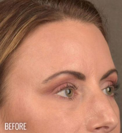 Dark Circles and Eyelid Bags Before & After Patient #1406