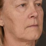 Skin Resurfacing Before & After Patient #1342