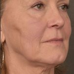 Skin Resurfacing Before & After Patient #1342