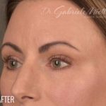 Dark Circles and Eyelid Bags Before & After Patient #1406