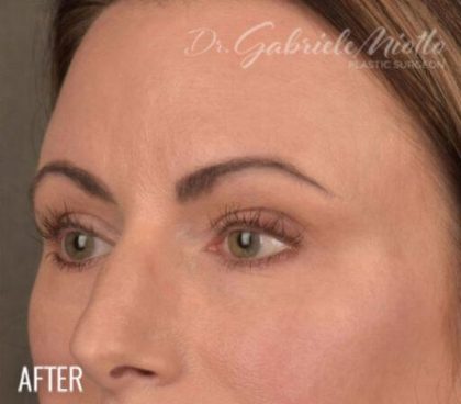 Dark Circles and Eyelid Bags Before & After Patient #1406