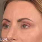 Dark Circles and Eyelid Bags Before & After Patient #1406