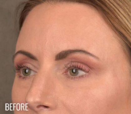 Dark Circles and Eyelid Bags Before & After Patient #1406