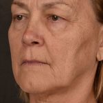Skin Resurfacing Before & After Patient #1342
