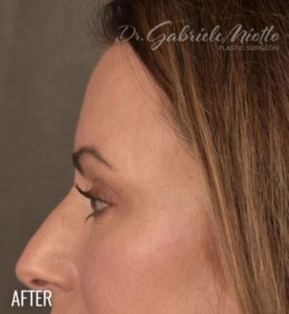 Dark Circles and Eyelid Bags Before & After Patient #1406