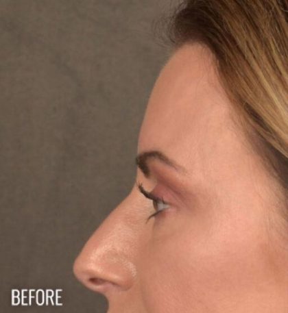 Dark Circles and Eyelid Bags Before & After Patient #1406