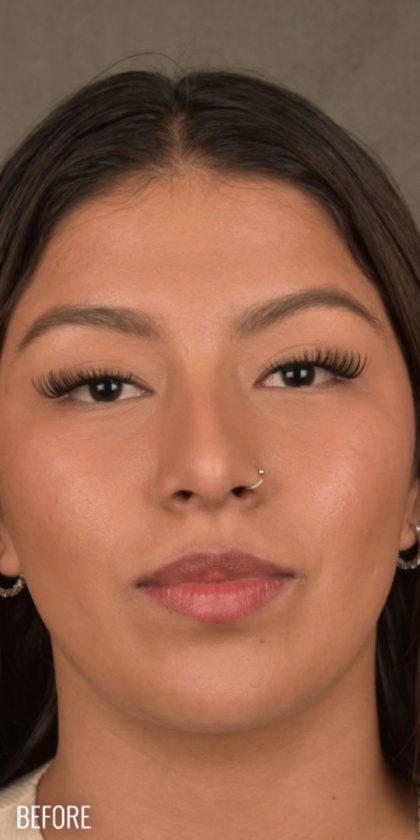 Non Surgical Rhinoplasty Before & After Patient #1313